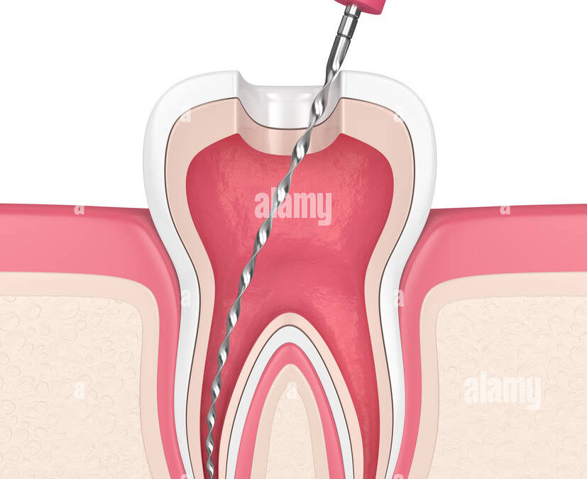 Root Canal Dressing: An Essential Step for Saving Your Tooth